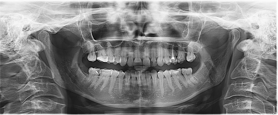 The Evolution of Preventive Dentistry Transitioning from Hygiene to Precision Occlusal Care